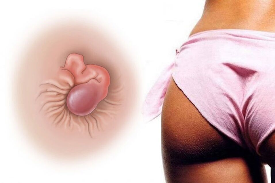 La crema natural cura las hemorroides en un curso
