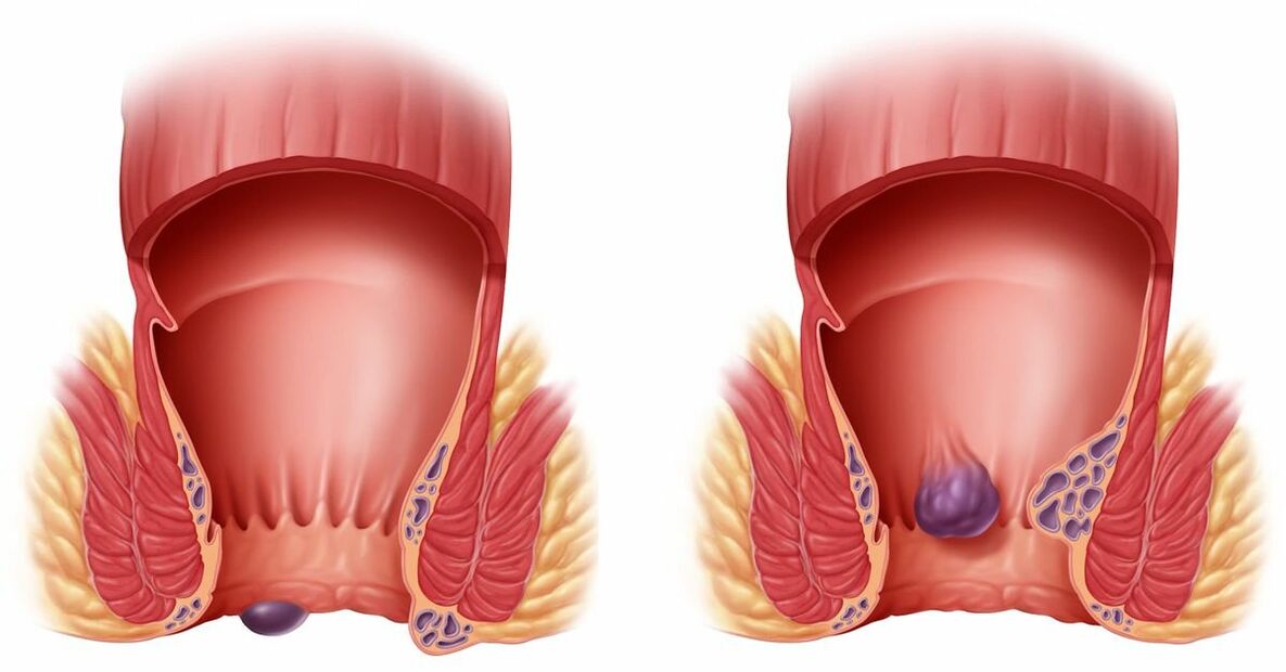 Zxcvbnmqwort ayuda con las hemorroides internas y externas